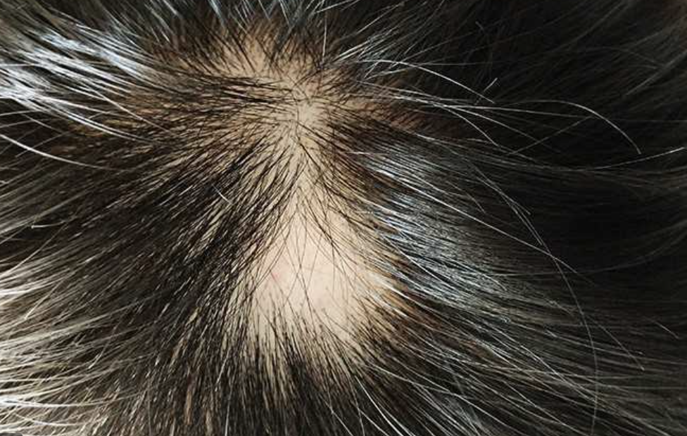 Children Hair and Scalp Problems London Hair & Skin Care Clinic Ltd