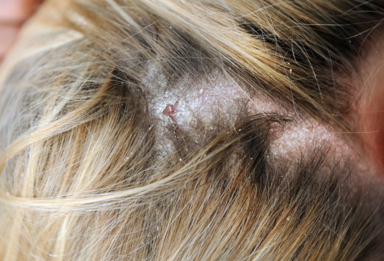 Hair & Scalp Conditions London Hair Care Clinic Ltd. Hair Loss