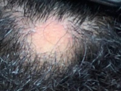Alopecia Areata - Beard - Temporary Hair Loss