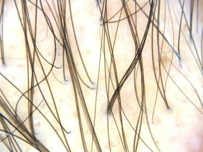 Pattern Hair Loss - Hair and Scalp Trichoscopy