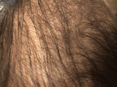 Pattern Hair Loss - Permanent Hair Loss