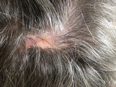 Immune System Disorder - Permenant Hair Loss