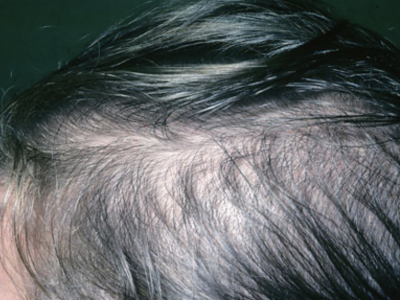 Hair Loss in Children - Nutrition deficiency