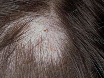 Fungi - Temporary Hair Loss