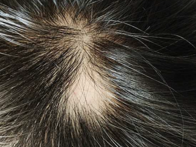 Alopecia Areata - Temporary Hair Loss