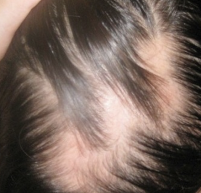 Trichotillomania - Permanent Hair Loss in Children