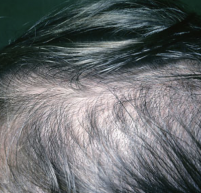 Hair Loss in Children - Nutrition deficiency