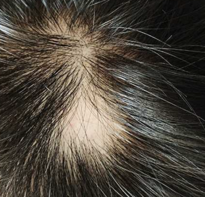 Alopecia Areata - Temporary Hair Loss